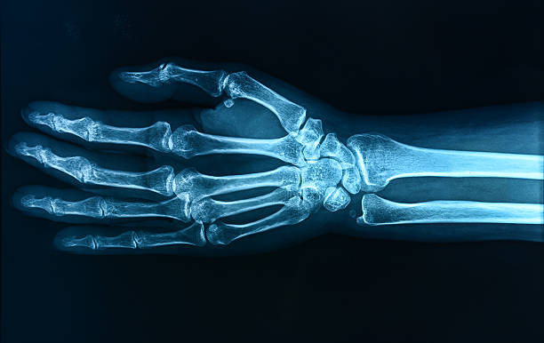 x-레이 손/다른 많은 x-선 영상을 내 작품집. - human bone x ray image pain condition 뉴스 사진 이미지