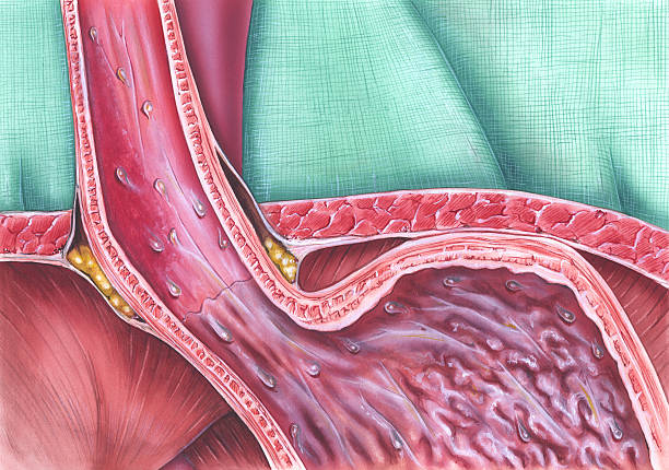 Gastroesophageal Reflux Disease Gastroesophageal reflux disease (GERD), caused when the lower esophageal sphincter (LES) does not close properly, and stomach contents leak back (reflux) into the esophagus. When refluxed stomach acid touches the lining of the esophagus, it causes a burning sensation (heartburn). GERD may lead to histopathological changes in the esophagus. sphincter stock illustrations