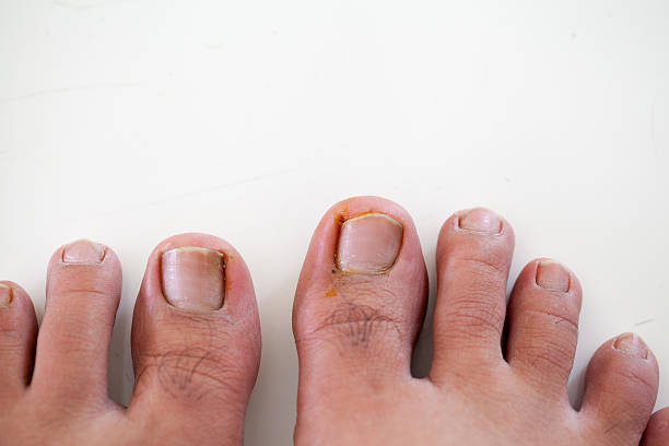 Toenail Pus Stock Photos, Pictures & Royalty-Free Images - iStock Toenail Pus Stock Photos, Pictures & Royalty-Free Images - iStock