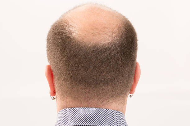 istock Premature baldness, man, 40s, white background 507994270