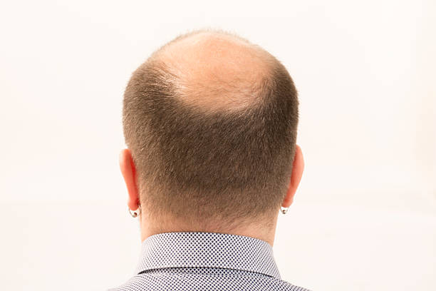 istock Premature baldness, man, 40s, white background 507994300