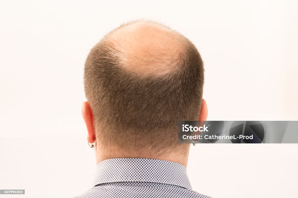 Premature baldness, man, 40s, white background 40s man with an incipient baldness , close-up, white background 35-39 Years Stock Photo