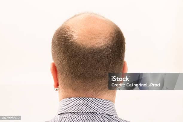 Premature Baldness Man 40s White Background Stock Photo - Download Image Now - 35-39 Years, Adult, Adults Only