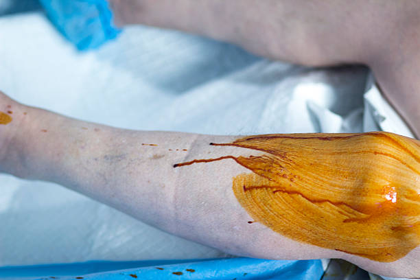 istock Sterilizing leg for orthopedic knee surgery 508100246