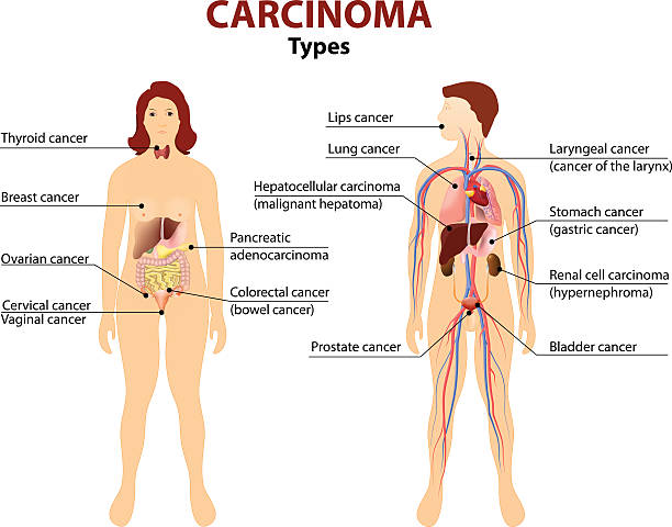 Carcinoma Carcinoma. Type of cancer. Woman and man silhouette with highlighted internal organs. male human anatomy diagram stock illustrations