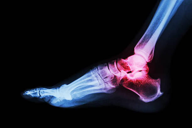 関節炎足首関節(痛風、関節リウマチ) - human foot barefoot sole of foot human toe ストックフォトと画像