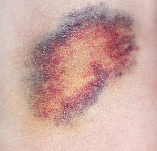 Bruise Bruise. Close-up photo bruise photos stock pictures, royalty-free photos & images