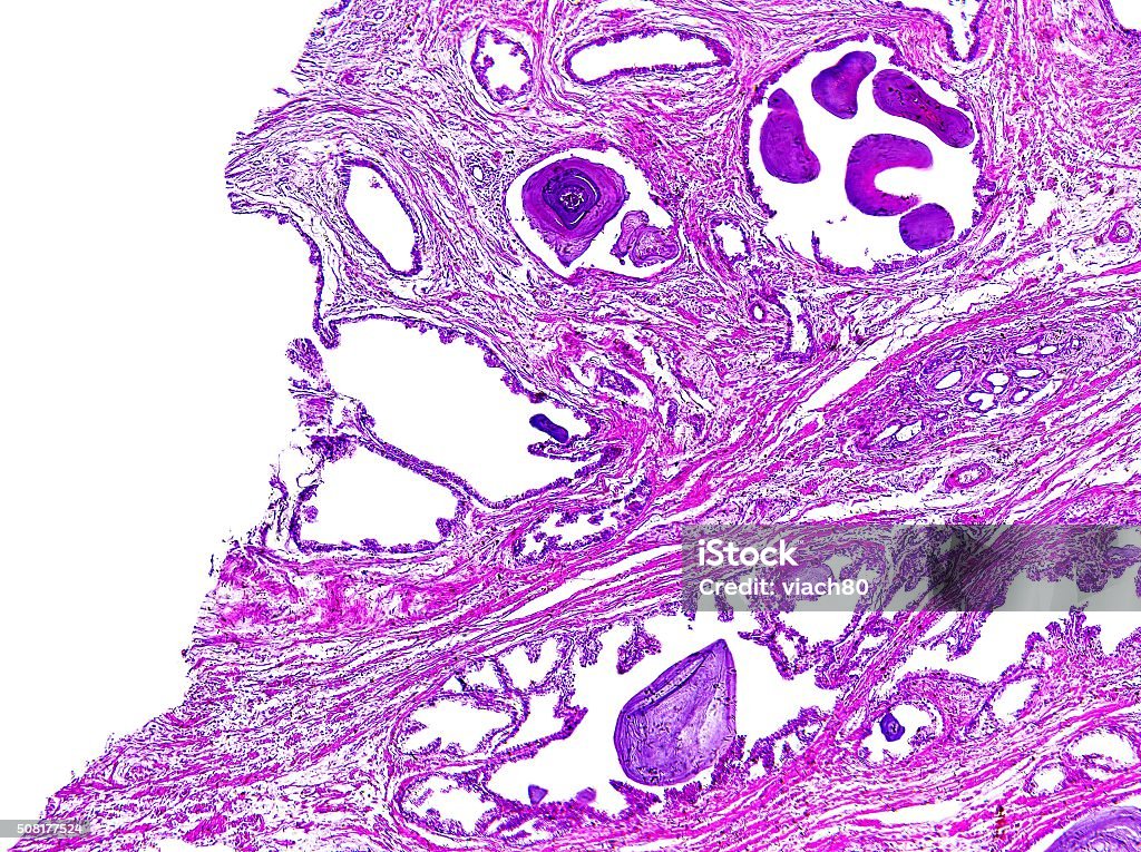 Hipertrofia de próstata humano - Foto de stock de Anatomía libre de derechos