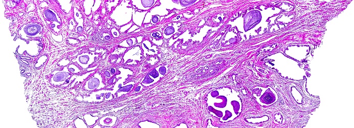 Prostate hypertrophy of a human, highly detailed panorama. Photomicrograph as seen under the microscope, 10x zoom.