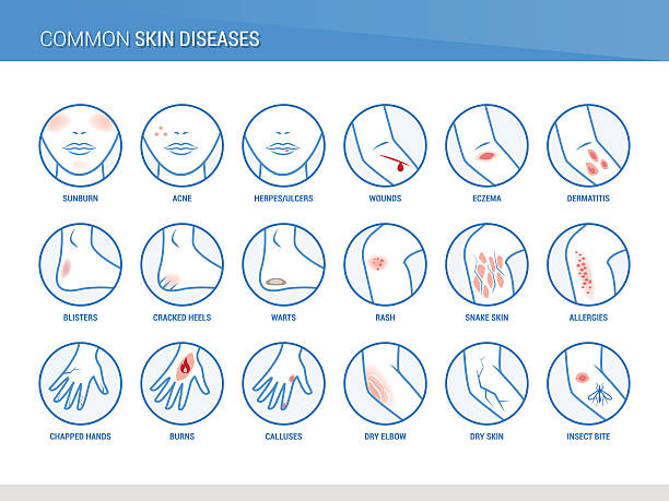 ilustraciones, imágenes clip art, dibujos animados e iconos de stock de enfermedades de la piel - dermatología
