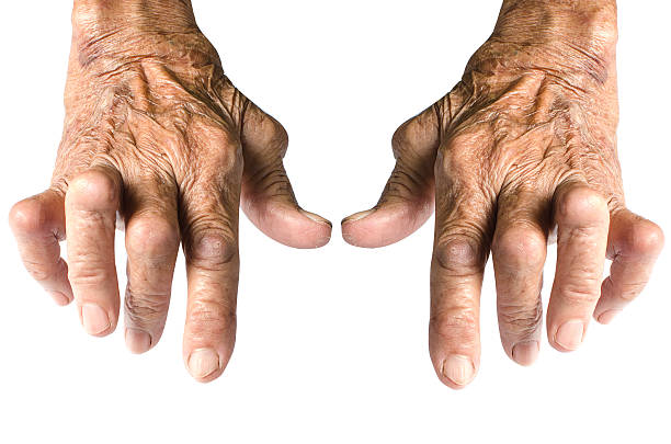 arthrite rhumatoïde seul sur fond blanc - rheumatism photos et images de collection
