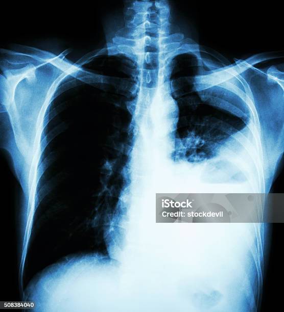Как выглядит рак легких на рентгеновском снимке Рак Легких - стоковые фотографии и другие картинки Бактерия туберкулёза - Бактер