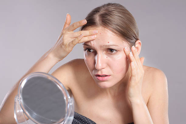 istock Young woman squeeze her acne in front of the mirror 508408792