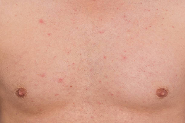 istock Blemishes on skin 508413572