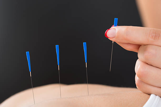istock Therapist Putting Acupuncture Needle On Woman's Back 508450944
