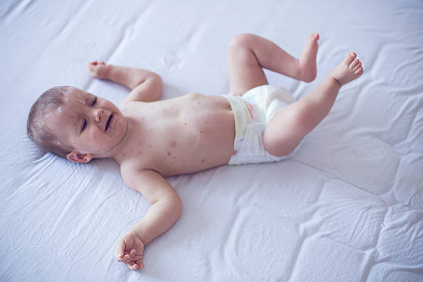 istock Crying baby girl with measles 508459394