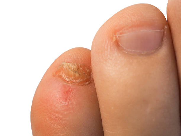 istock The problem pinky nail feet on a white background 508523480