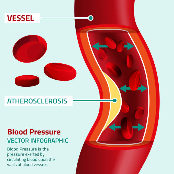 illustrazioni stock, clip art, cartoni animati e icone di tendenza di pressione sanguigna infografica - human artery cholesterol atherosclerosis human heart