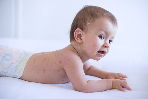 istock Baby girl with chickenpox 508756892