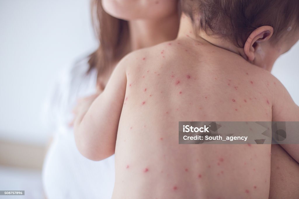 Madre cuidado de bebé con varicela - Foto de stock de Varicela libre de derechos