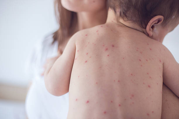 madre prendersi cura dei bambini con pollo esantema - chickenpox skin condition baby illness foto e immagini stock