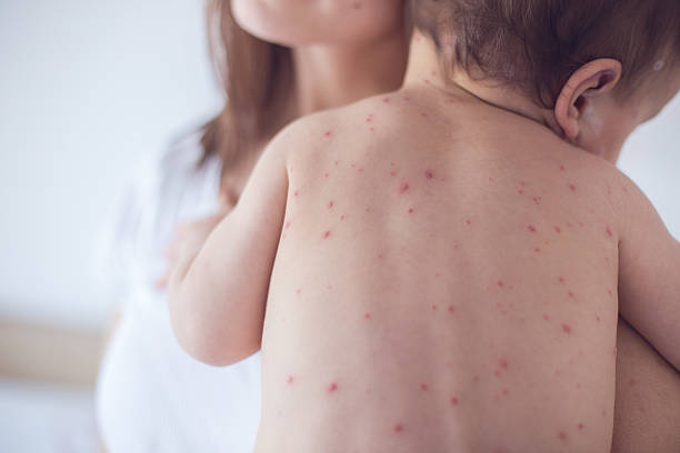 구슬눈꼬리 치료 아기 치킨 두창 - chickenpox skin condition baby illness 뉴스 사진 이미지