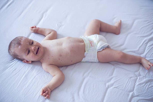 istock Crying baby girl with measles 508758288