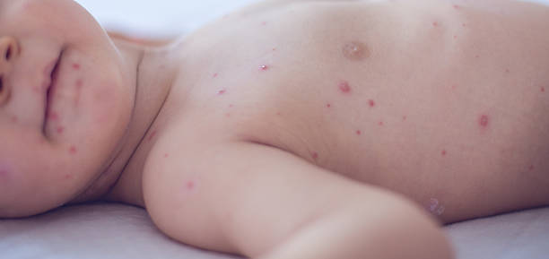 istock Baby girl with chickenpox 508758394