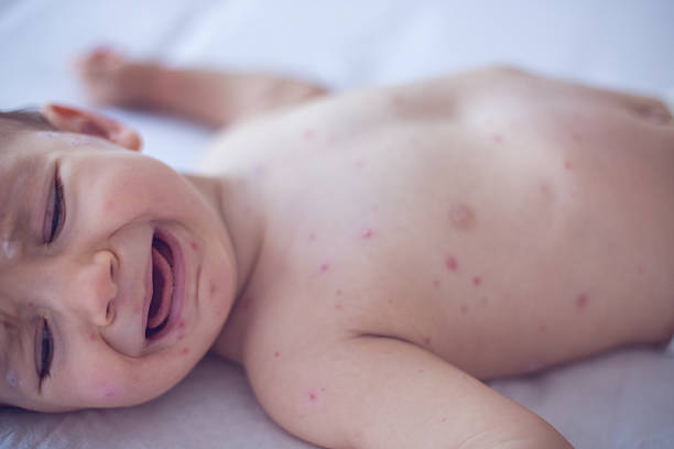 istock Crying baby girl with measles 508758480