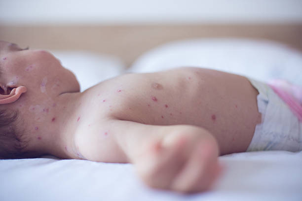istock Baby girl with chickenpox 508758544