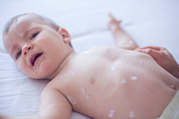 istock Crying baby girl with measles 508758942
