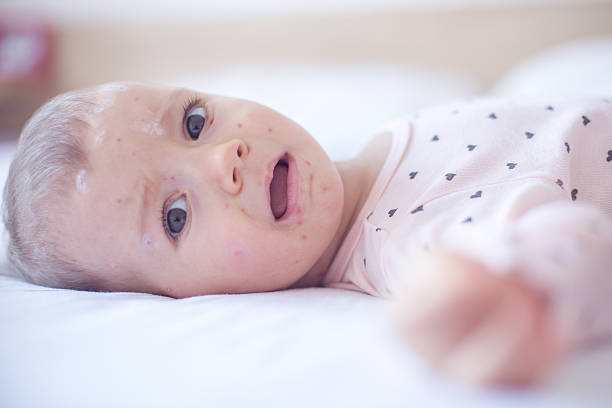 istock Baby girl with chickenpox 508759094