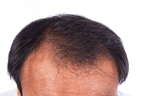 istock bald head of young man on white background 508833996