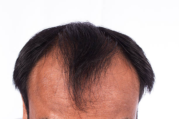 istock bald head of young man on white background 508834592