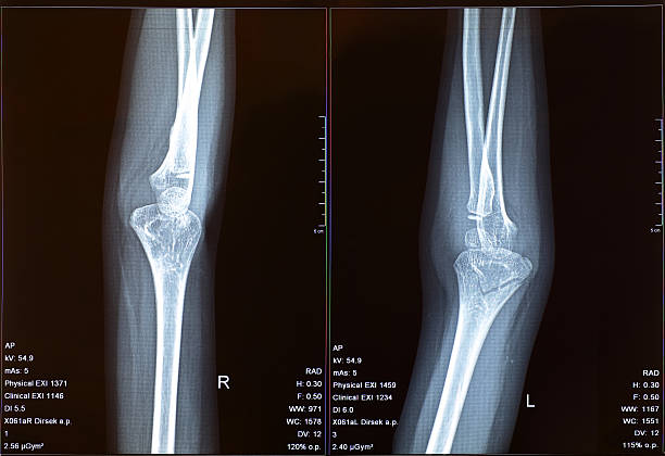 X ray image of elbows stock photo