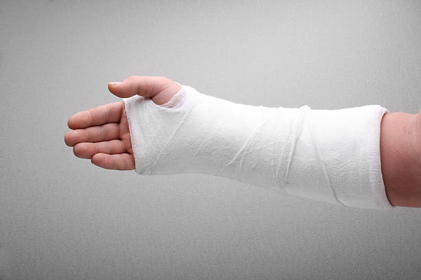 Broken arm bone in cast Broken arm bone in cast orthopedic cast stock pictures, royalty-free photos & images