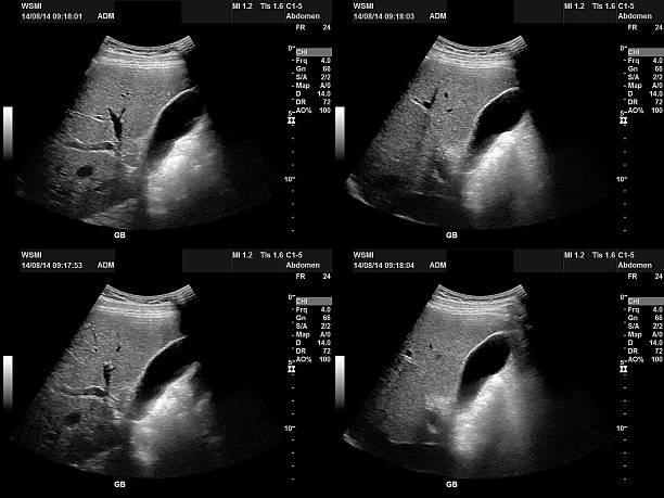 istock Gall bladder ultrasound with doppler 508906957