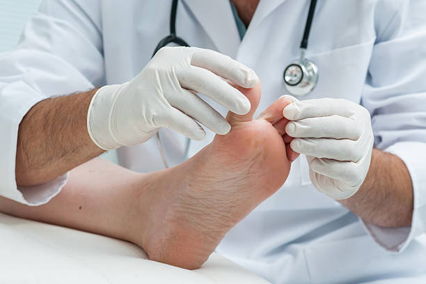 tinia pedis lub sportowców stóp - podiatry chiropody toenail human foot zdjęcia i obrazy z banku zdjęć