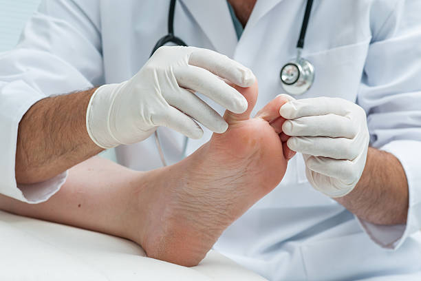 tinia dorsal ou pé de atleta - fungus toenail human foot onychomycosis imagens e fotografias de stock