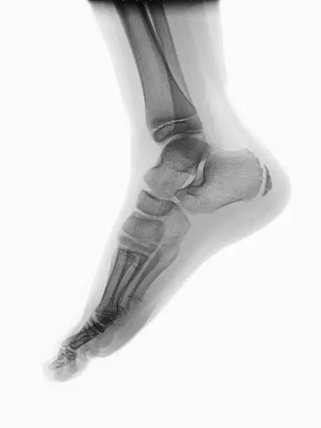Human foot on roentgenogram