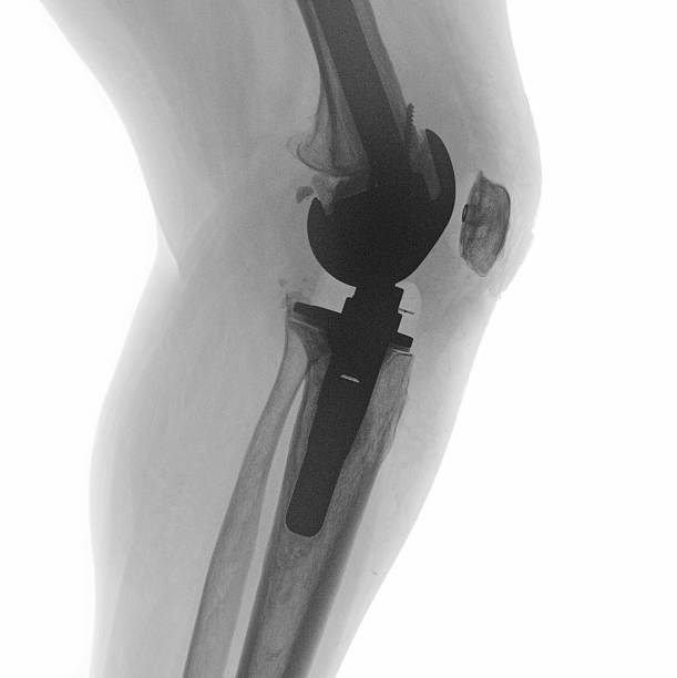 인공 무릎 관절 - x ray human knee orthopedic equipment human bone 뉴스 사진 이미지