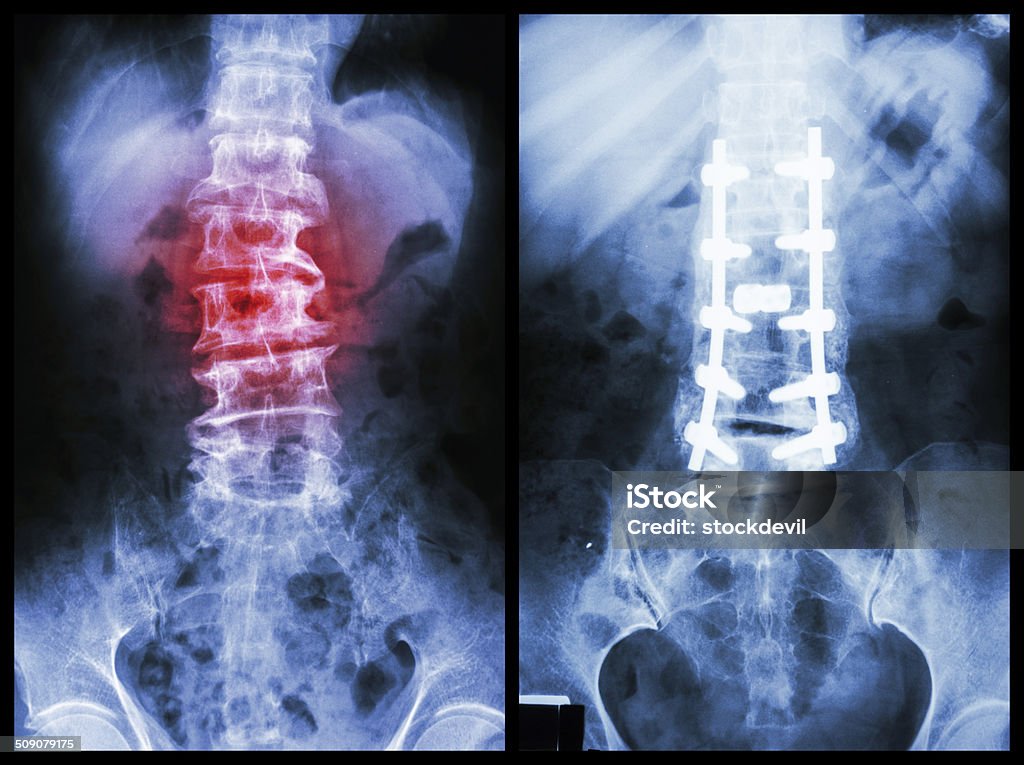 "Spondylosis" "Spondylosis" (Left image) , Patient was operated and internal fixed. (Right image) X-ray Image Stock Photo