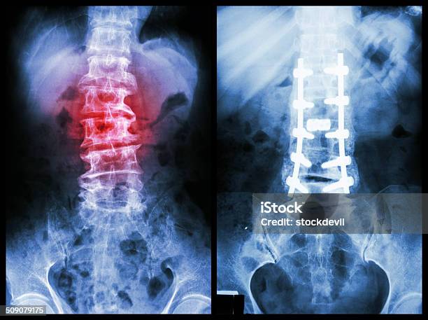 Spondylosis Stock Photo - Download Image Now - X-ray Image, Bone Fracture, Back