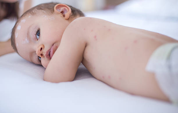 istock Baby girl with chickenpox 509105972