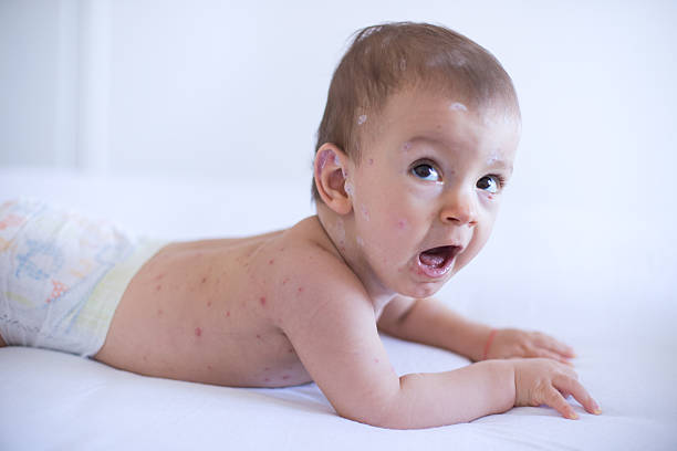 istock Baby girl with chickenpox 509106260