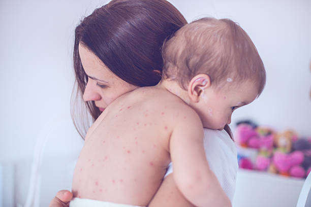 Mother taking care of baby with chicken pox Mother nursing sick child At Home measles stock pictures, royalty-free photos & images