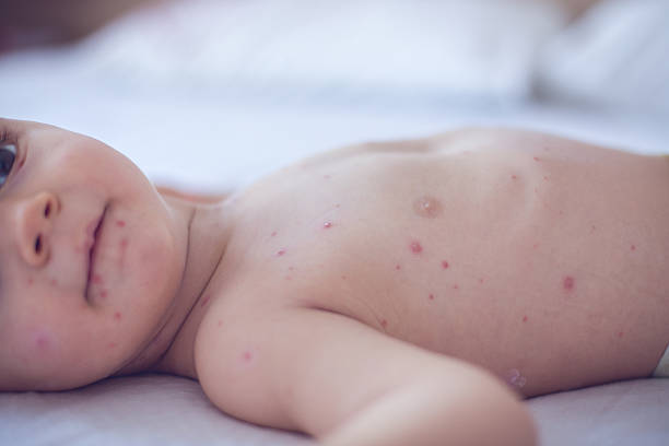istock Baby girl with chickenpox 509107020