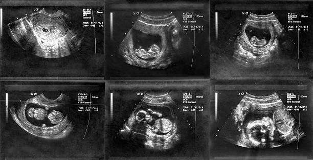 istock Ultrasound scanning of fetal 509251116