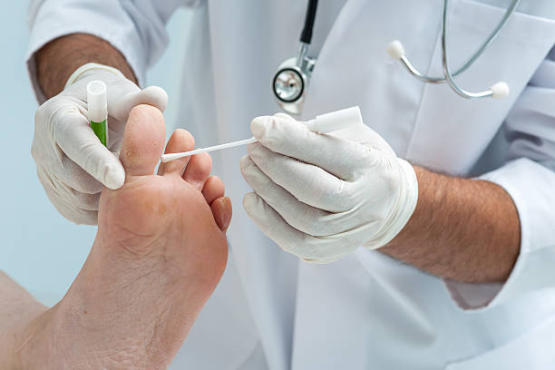 Tinia pedis or Athletes foot Doctor dermatologist examines the foot on the presence of athletes foot trichophyton fungus stock pictures, royalty-free photos & images