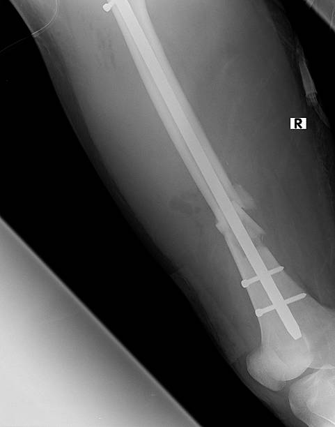 istock Upper part of broken human thigh with steel screw x-ray 509294194